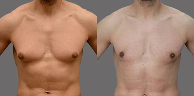 Front view showing refined chest contour after gynecomastia surgery.