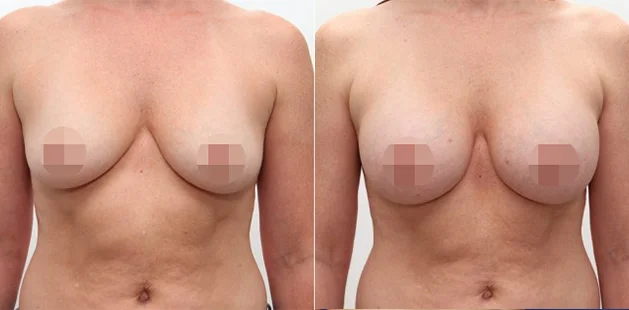 Ditesheim Cosmetic Surgery breast augmentation before and after highlighting enhanced volume.