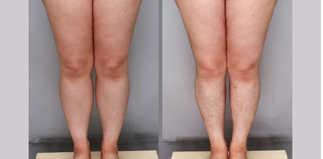 Stage 1 leg liposuction outcome for 34-year-old, 5'3" 158 lbs patient at Ditesheim Cosmetic Surgery in Charlotte NC