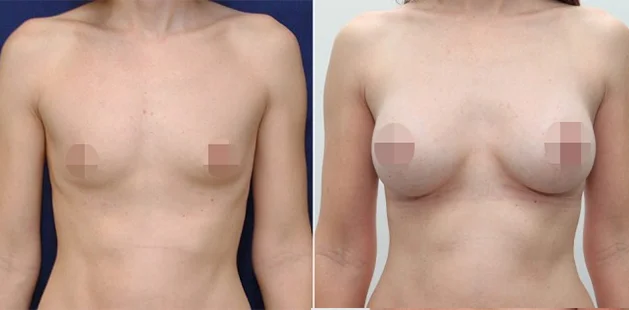 Breast implant results showing restored fullness and youthful contour at Ditesheim Cosmetic Surgery.