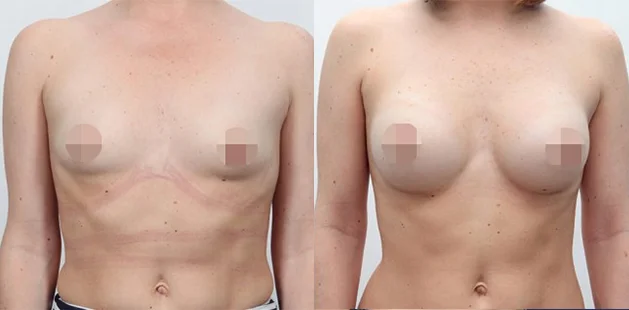 Breast implant enhancement with improved shape and projection before and after.