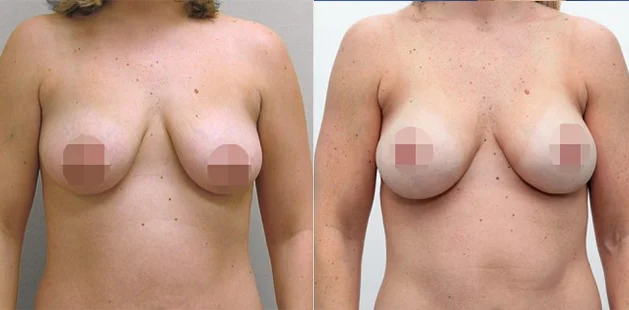 Before and after breast lift with augmentation age 30, 36A to 34C, 5'4 125 lbs, Ditesheim Cosmetic Surgery Charlotte NC