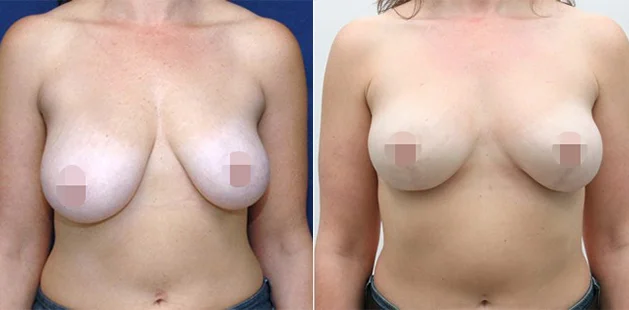 Before and after breast lift age 34, bra 34DD to 34D, Ditesheim Cosmetic Surgery clinic in Charlotte North Carolina