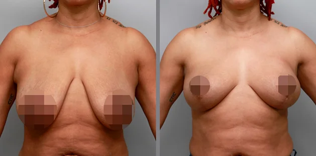 Breast lift results age 46, 5'4" 166 lbs, 36D to 36C transformation at Ditesheim Cosmetic Surgery Charlotte North Carolina