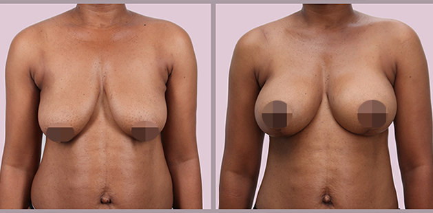 Before and after breast lift with augmentation, age 42, 34C to 34D results at Ditesheim Cosmetic Surgery