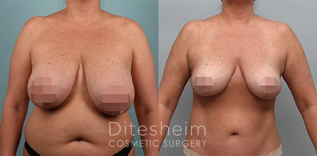 47-year-old 5'10 189 lbs breast reduction 38DD to 38C with tummy tuck and liposuction at Ditesheim Cosmetic Surgery Charlotte NC