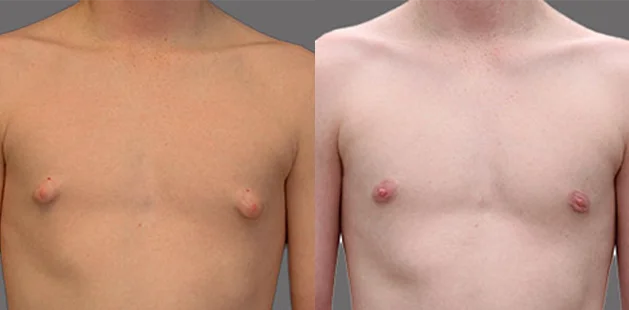 Gynecomastia treatment results revealing more toned, masculine chest shape.
