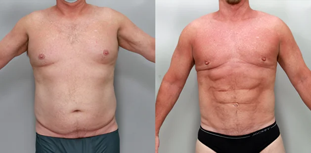 Front view of male liposuction results showing reduced fat and improved back contour.