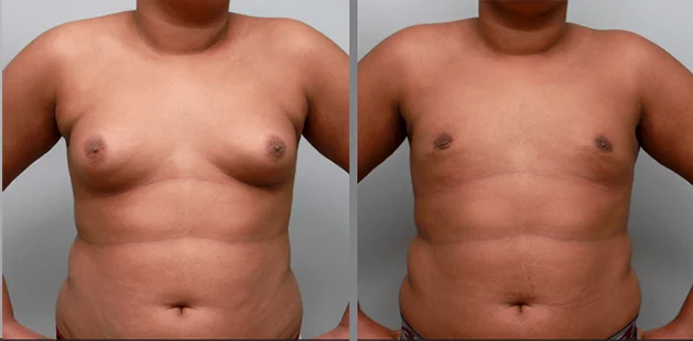 Gynecomastia surgery results from right angle showing reduced breast fullness and defined chest.