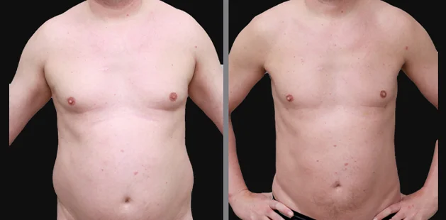 Front view of male liposuction results showing reduced fat and improved back contour.