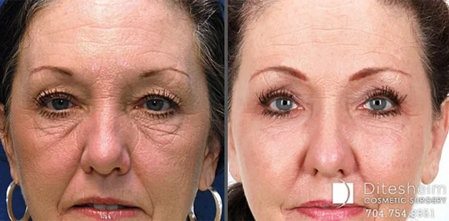 Before and after lower facelift showing improved jawline definition and tighter skin | Facial rejuvenation before and after at Ditesheim Cosmetic Surgery Charlotte