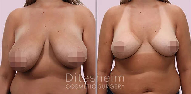 Breast reduction transformation age 24 height 5'4 weight 142 lbs from 36DD to 36C at Ditesheim Cosmetic Surgery
