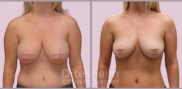 29-year-old breast reduction patient, 5'0 110 lbs, 34DD to 32D results at Ditesheim Cosmetic Surgery, Charlotte
