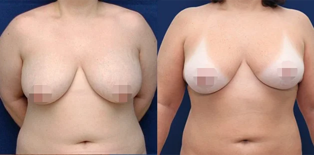 36-year-old, 5'2" 190 lbs, breast reduction and liposuction, 38D to 36C results at Ditesheim Cosmetic Surgery, Charlotte