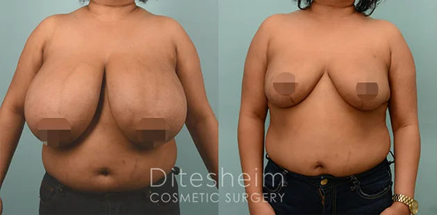 Breast reduction before and after photo showing improved shape and proportion at Ditesheim Cosmetic Surgery.