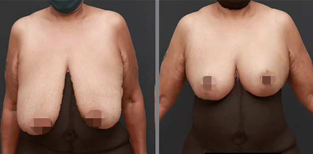 Before and after breast reduction results showing smaller, lifted breasts with enhanced contour.
