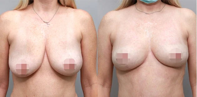 Natural breast contour after implant removal and lift for 49-year-old patient at Ditesheim Cosmetic Surgery Charlotte
