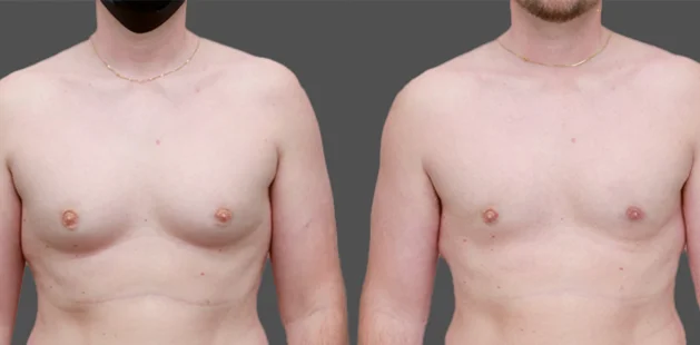 Male chest before and after gynecomastia surgery showing refined contour – Charlotte NC.
