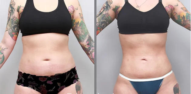Patient age 24, 5'5 138 lbs showing liposuction full-body contouring results at Ditesheim Cosmetic Surgery, Charlotte NC
