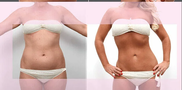 Body contouring results age 42, 5'4 134 lbs after tummy tuck, liposuction, lipo 360 mommy makeover Ditesheim Cosmetic Surgery Charlotte