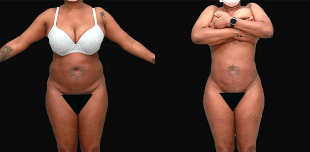 Liposuction and Renuvion tummy tuck before after at Ditesheim Cosmetic Surgery Charlotte NC showing 48-year-old body contouring results