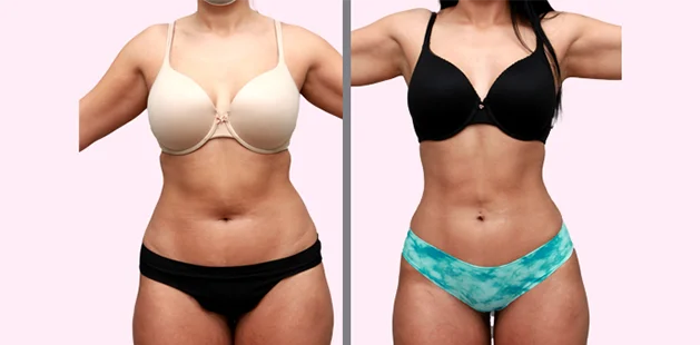 Liposuction results for 31-year-old male, 5'10 180 lbs, enhanced body definition at Ditesheim Cosmetic Surgery in Charlotte NC