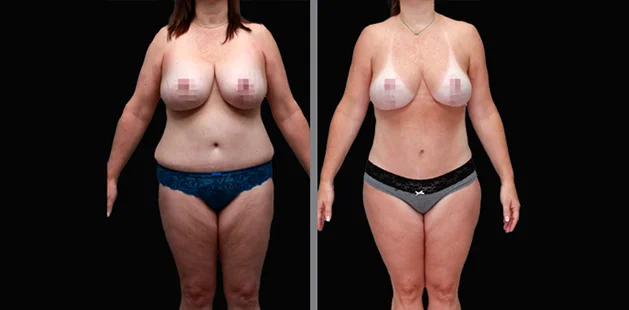 Before and after plastic surgery gallery showing full-body contouring results at Ditesheim Cosmetic Surgery.