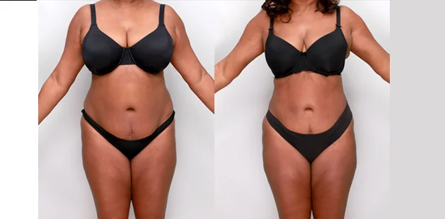 Liposuction and tummy tuck before and after results for enhanced body definition.