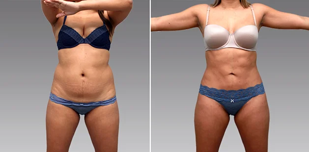 Plastic surgery results featuring tummy tuck, lipo 360, and mommy makeover procedures.