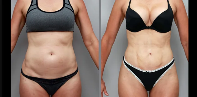 Liposuction and tummy tuck before and after results for enhanced body definition.