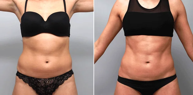 Liposuction and tummy tuck before and after results for enhanced body definition.