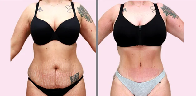 Plastic surgery results featuring tummy tuck, lipo 360, and mommy makeover procedures.