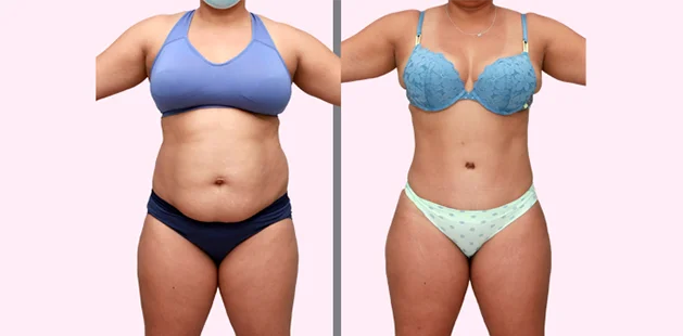 Before and after body contouring and breast enhancement after pregnancy.