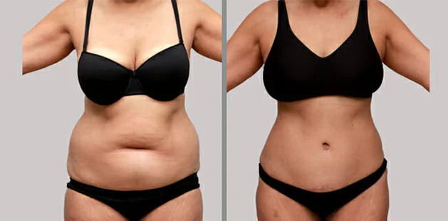 Comprehensive mommy makeover showing improved waistline and lifted bust.