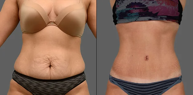 Mommy makeover results with tummy tuck and liposuction on 33-year-old patient at Ditesheim Cosmetic Surgery Charlotte NC