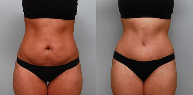 Breast lift and tummy tuck before and after results for post-pregnancy transformation.