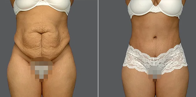 Before and after body contouring and breast enhancement after pregnancy.