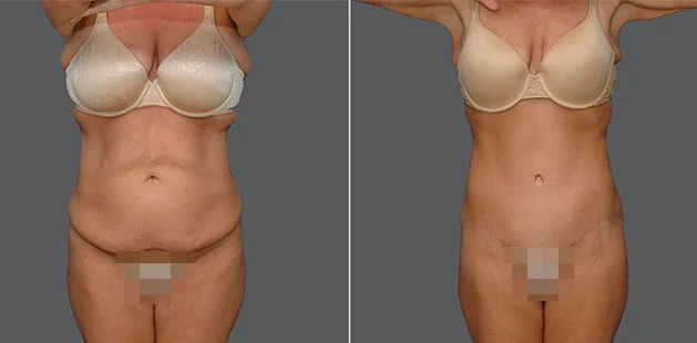 Before and after body contouring and breast enhancement after pregnancy.