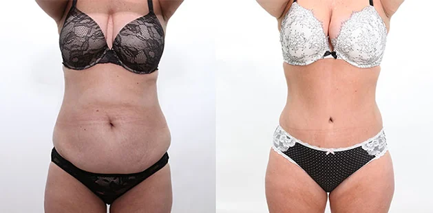 Plastic surgery before and after results showing full-body contouring for moms.