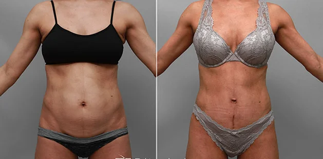 Before and after body contouring and tummy tuck after pregnancy.