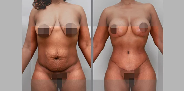 Mommy makeover showing restored body shape and tighter abdomen, front view.