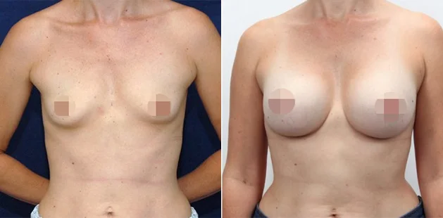 Breast augmentation results showing increased volume and balanced contour.