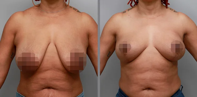 Mommy makeover showing restored body shape and tighter abdomen.