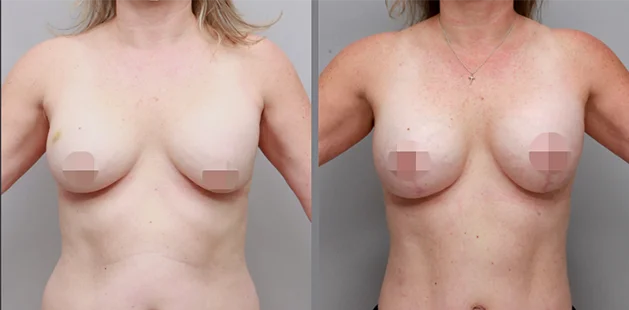 Mommy makeover results highlighting tummy tuck and breast lift contour improvement.
