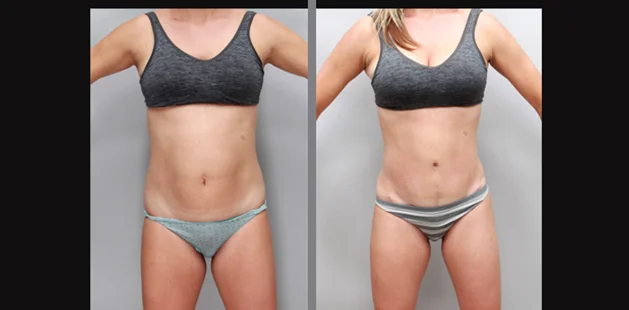 Plastic surgery before and after results showing full-body contouring for moms.