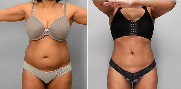Abdominoplasty and breast enhancement before and after transformation.