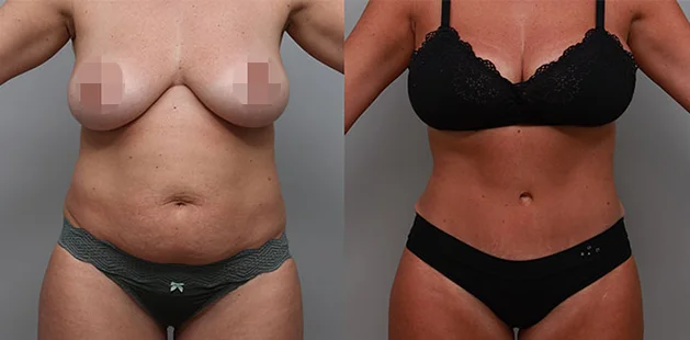 Before and after body contouring and breast enhancement after pregnancy.