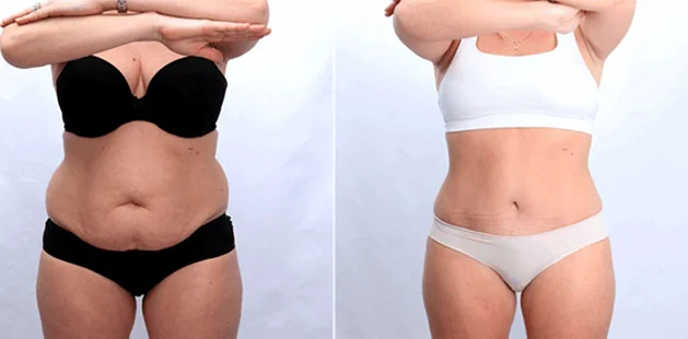 Abdominoplasty and breast enhancement before and after transformation.