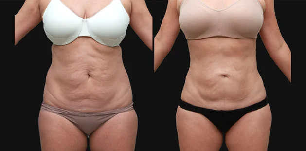 Before and after body contouring and breast enhancement after pregnancy.