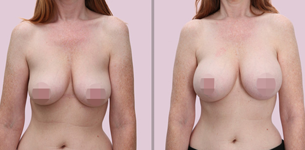 Breast augmentation results age 41 5'6 130lbs before 34D after 34DD Ditesheim Cosmetic Surgery Charlotte NC